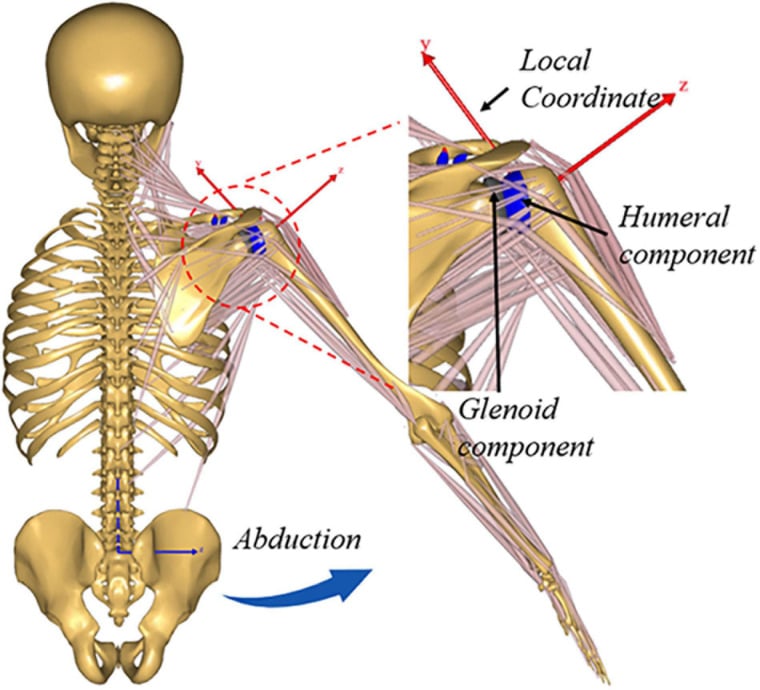 3D musculoskeletal model of shoulder joint showing muscle architecture and arthroplasty components