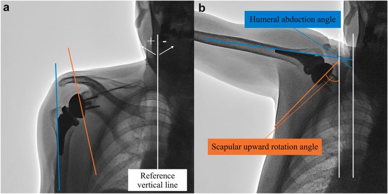 Radiographs with reference lines defining the humeral abduction angle and the scapular upward rotation angle against a vertical line