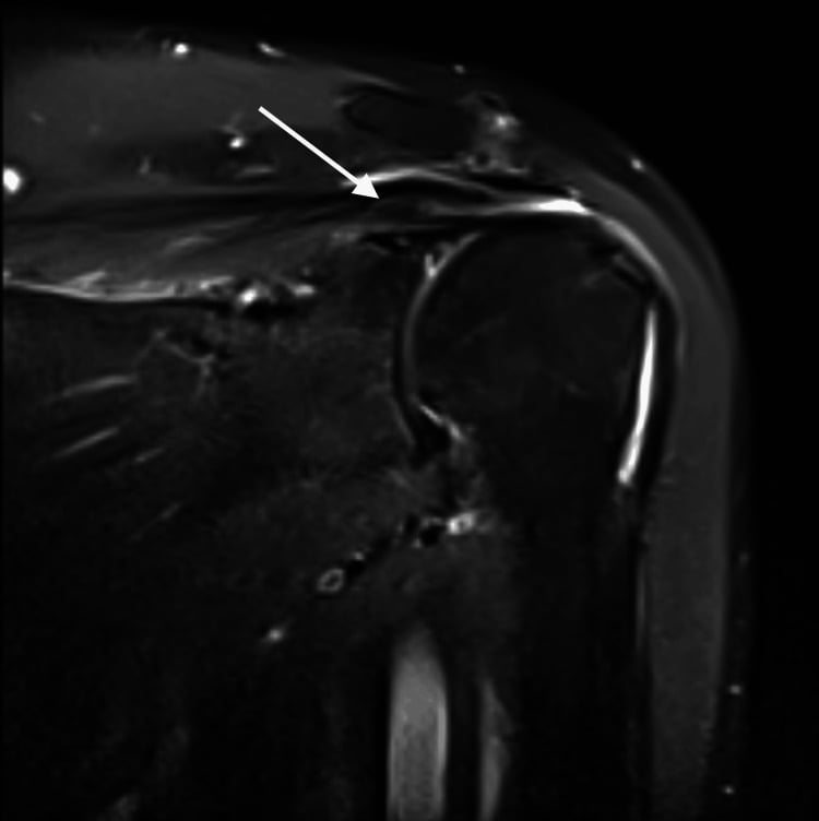 Proton density fat-suppressed MRI of the shoulder showing discontinuity and retraction of the supraspinatus tendon fibres