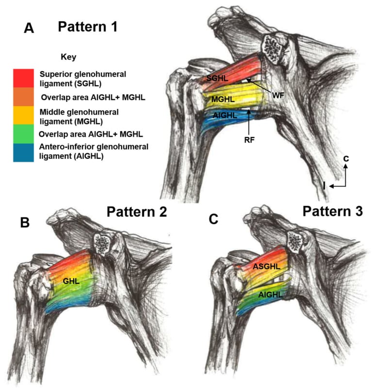 Three colour-coded anterior views of the glenohumeral ligament patterns showing superior, middle and antero-inferior ligaments and their overlap variants