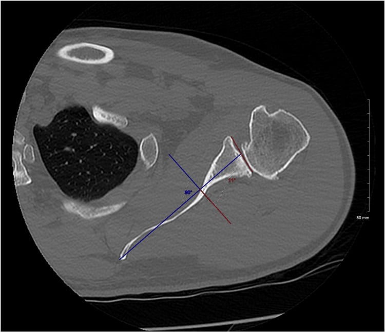 Axial CT of the shoulder with glenoid version measured as the angle between the glenoid face and a line perpendicular to the scapular axis