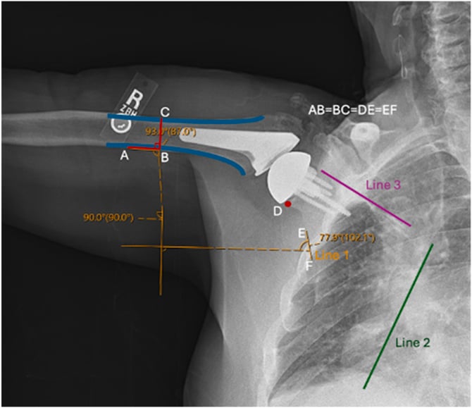 Radiograph with vertical and horizontal reference lines drawn to measure glenohumeral and scapulothoracic contributions to arm elevation