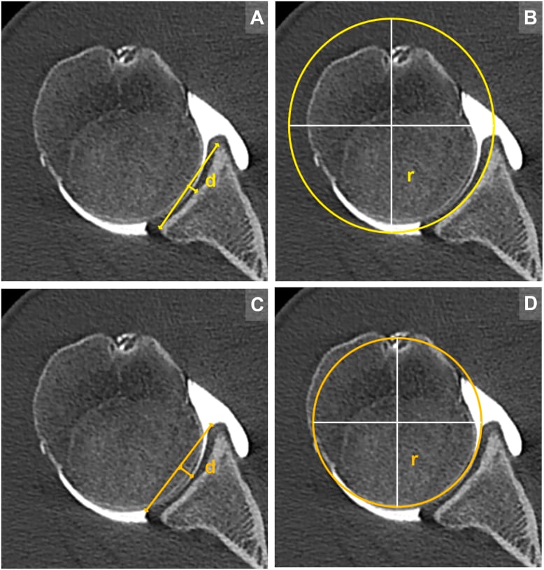 Axial CT panels showing measurement of bony glenoid concavity depth and radius alongside the labral concavity used to calculate the bony and labral shoulder stability ratios