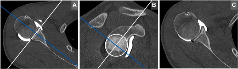 Three-dimensional multiplanar CT reconstruction with axes adjusted perpendicular to the glenoid face and parallel to the scapular body for standardised slice orientation