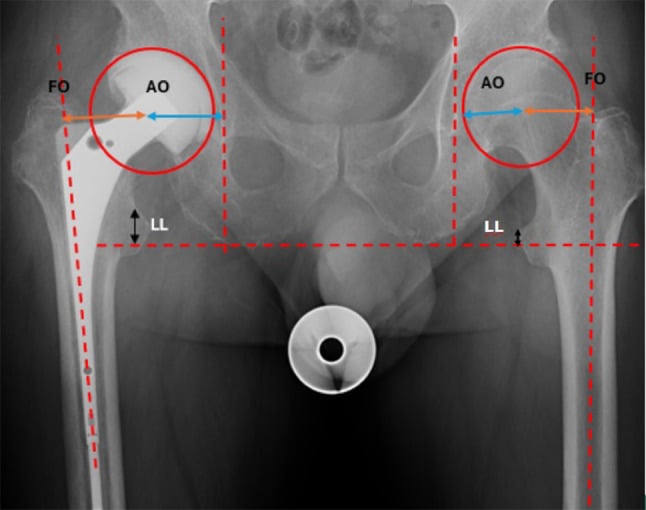 Anteroposterior pelvis radiograph after hip arthroplasty labelled with femoral offset, acetabular offset and leg length