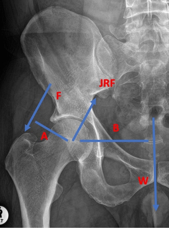 Anteroposterior hip radiograph overlaid with abductor force, body weight and joint reaction force vectors and their moment arms