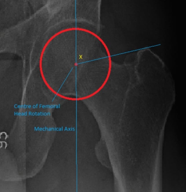 Standing long-leg radiograph showing the mechanical greater trochanter angle between the mechanical axis and the greater-trochanter-to-head line
