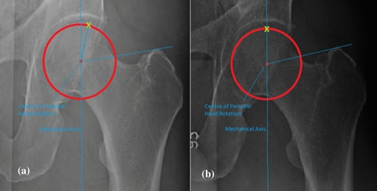 Pre- and post-osteotomy hip radiographs showing an increase in mechanical greater trochanter angle