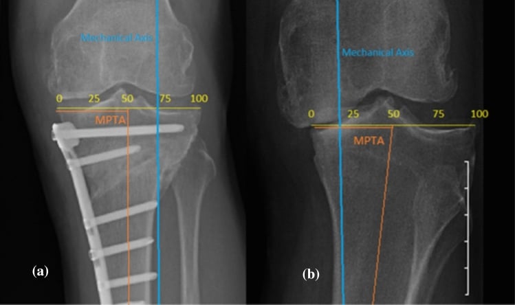 Pre- and postoperative long-leg radiographs showing change in mechanical axis deviation and medial proximal tibial angle