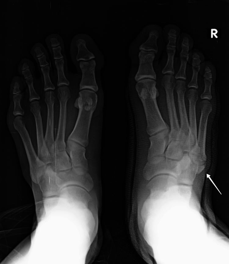 Bilateral foot radiographs showing an accessory ossicle at the fifth metatarsal base on one side only