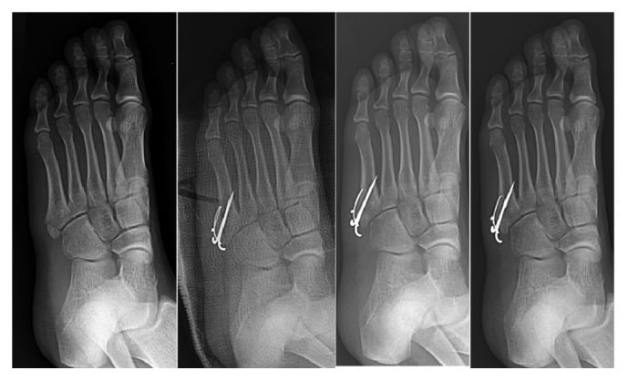 Serial radiographs before surgery and at one, three and six months after intramedullary screw fixation with early weightbearing
