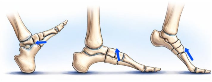 Schematic of resultant force vectors applied to the fifth metatarsal through the phases of gait