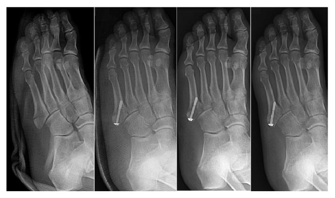 Serial radiographs before surgery and at one, three and six months after fixation with delayed weightbearing