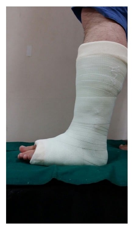 Lateral view of a short-leg cast applied for non-operative treatment of a proximal fifth metatarsal fracture