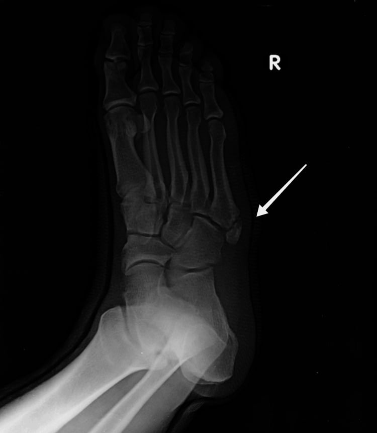 Oblique foot radiograph showing an os vesalianum pedis proximal to the fifth metatarsal base