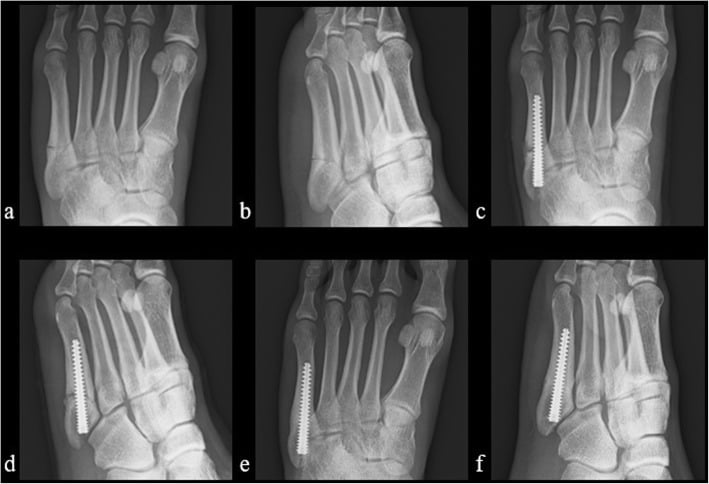 Preoperative, immediate postoperative and eleven-week radiographs after intramedullary screw fixation of a proximal fifth metatarsal stress fracture