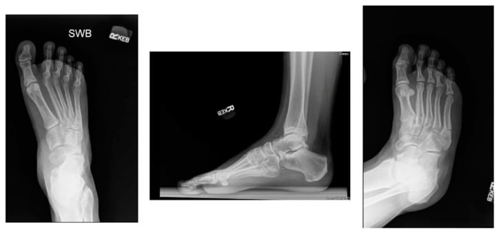 Weight-bearing AP, lateral and oblique radiographs of an acute non-displaced Jones fracture