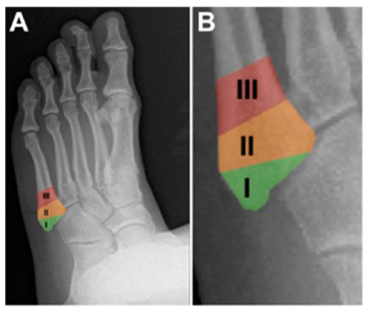 Normal foot radiograph with the three proximal fifth metatarsal zones colour-coded and magnified