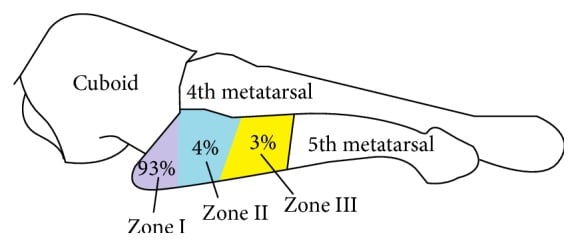 Diagram of proximal fifth metatarsal zones with the proportion of fractures occurring in each