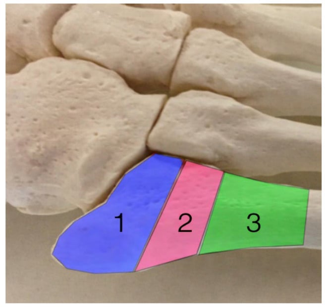Cadaveric fifth metatarsal specimen with zones one to three marked over the tuberosity, junction and diaphysis
