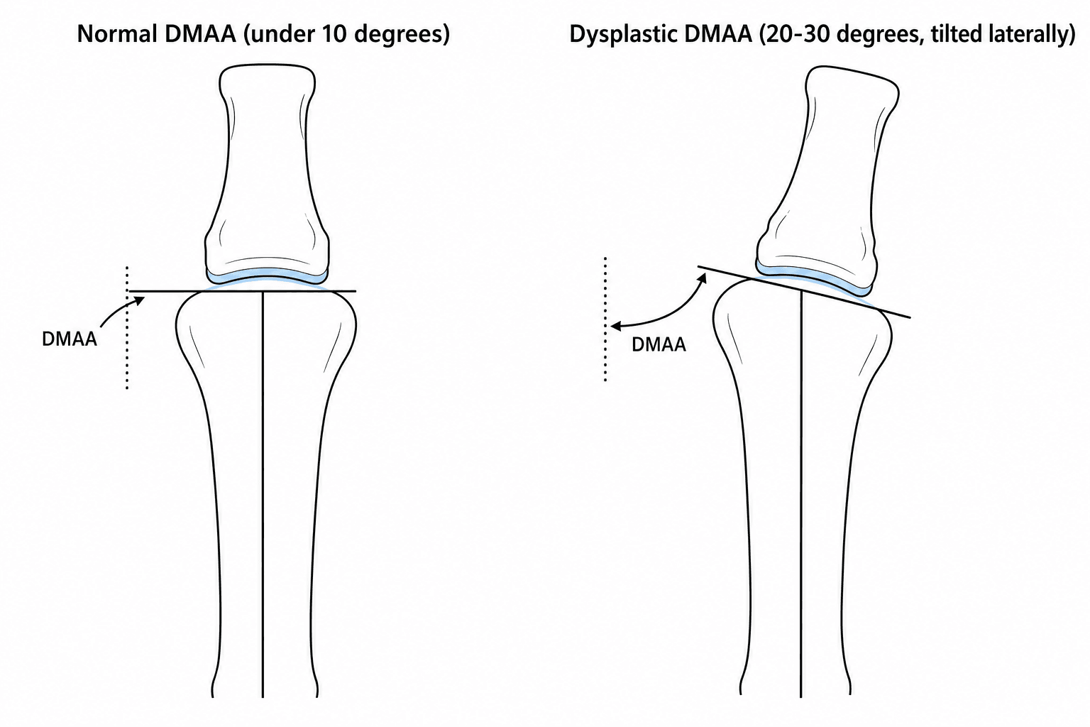 Schematic diagram comparing normal and dysplastic Distal Metatarsal Articular Angle (DMAA)