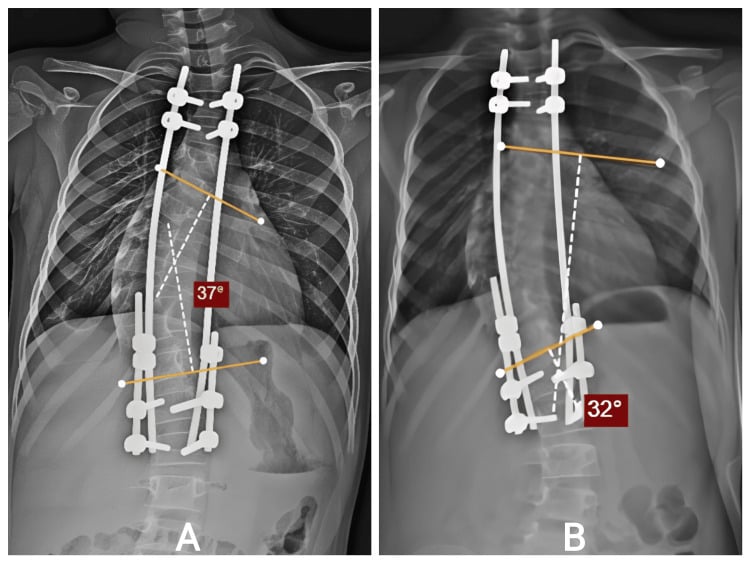 Serial AP radiographs after dual growing rod implantation and later distraction in early-onset scoliosis
