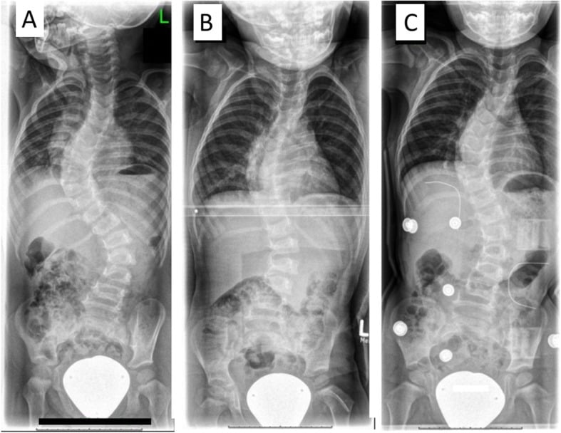 Serial whole-spine radiographs before casting after the first cast and after transition to a brace