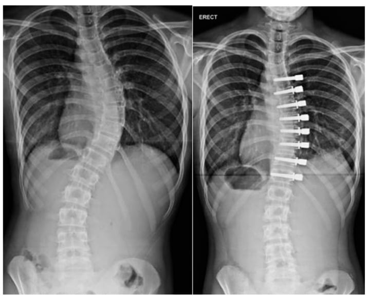 Preoperative and postoperative standing AP radiographs after anterior vertebral body tethering for early-onset scoliosis