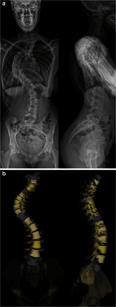 EOS biplanar imaging demonstrating severe pediatric idiopathic scoliosis