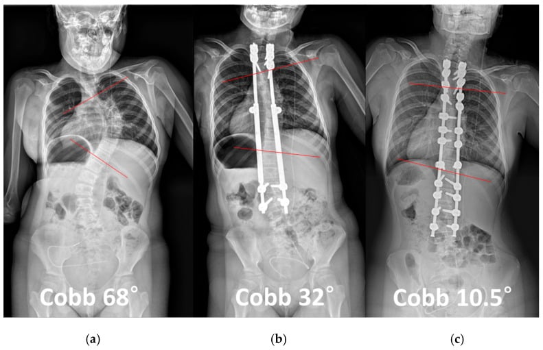 Serial AP whole-spine radiographs before growing rods after lengthening and after definitive fusion