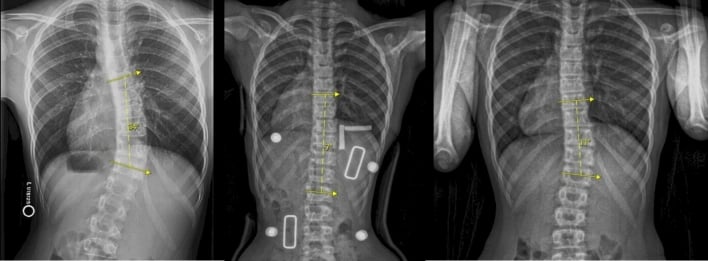 Standing radiographs before bracing in brace and after brace treatment for juvenile idiopathic scoliosis