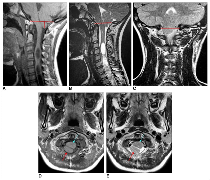 Sagittal, coronal and axial MRI panels showing a Chiari I malformation with a cervical syrinx in a juvenile with progressive scoliosis