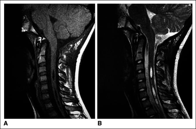 Sagittal cervical MRI after Chiari decompression showing restored foramen-magnum space and regression of a cervical syrinx