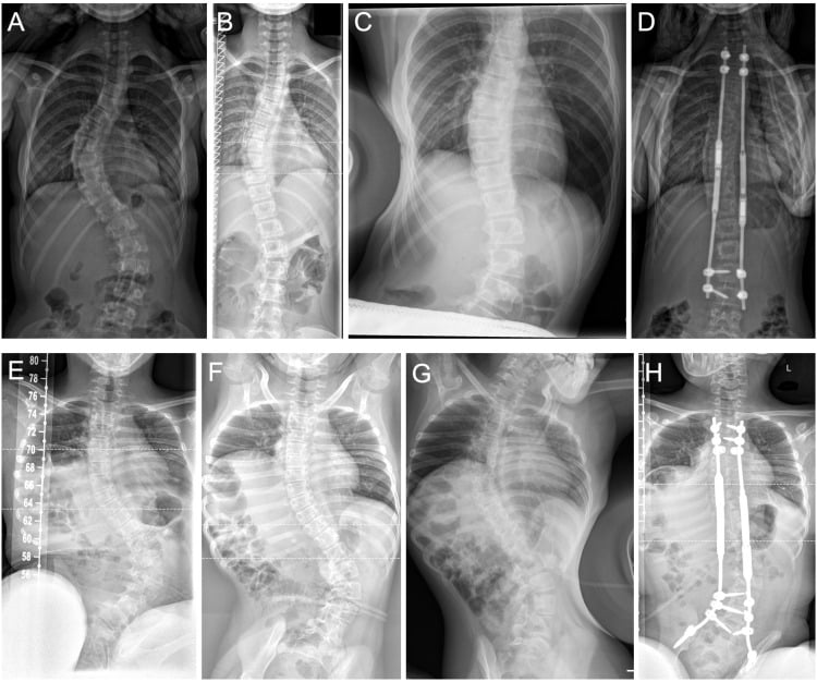 Standing traction and fulcrum-bending radiographs with postoperative MCGR correction in idiopathic and neuromuscular scoliosis