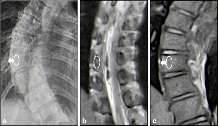 Nash-Moe vertebral rotation measurement on a PA radiograph with corresponding coronal real-time MRI
