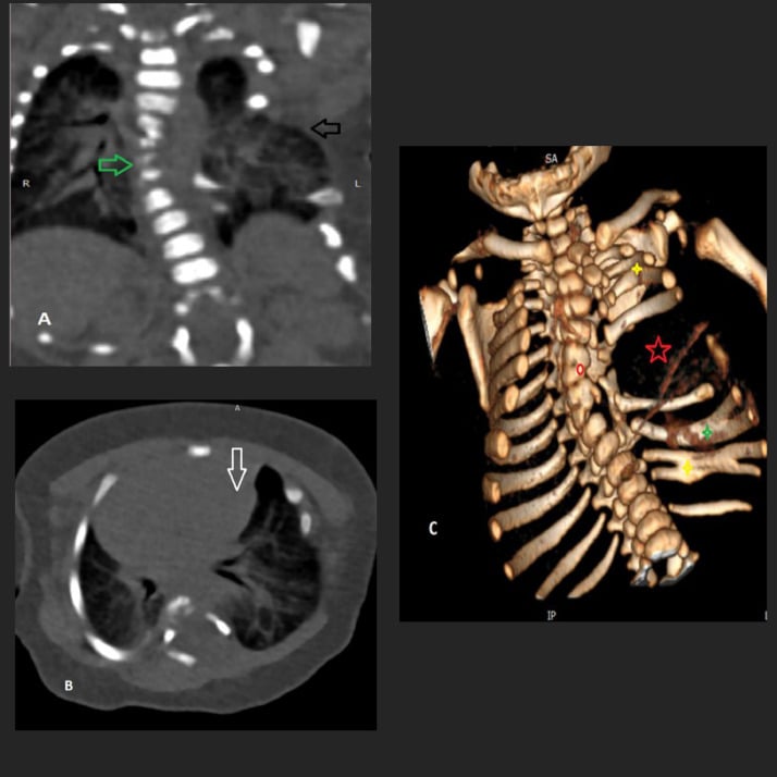Coronal and axial chest CT with three-dimensional reconstruction showing absent fused and bifid ribs with lung herniation