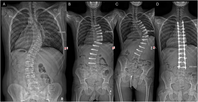Serial standing radiographs showing vertebral body tethering overcorrection followed by posterior fusion