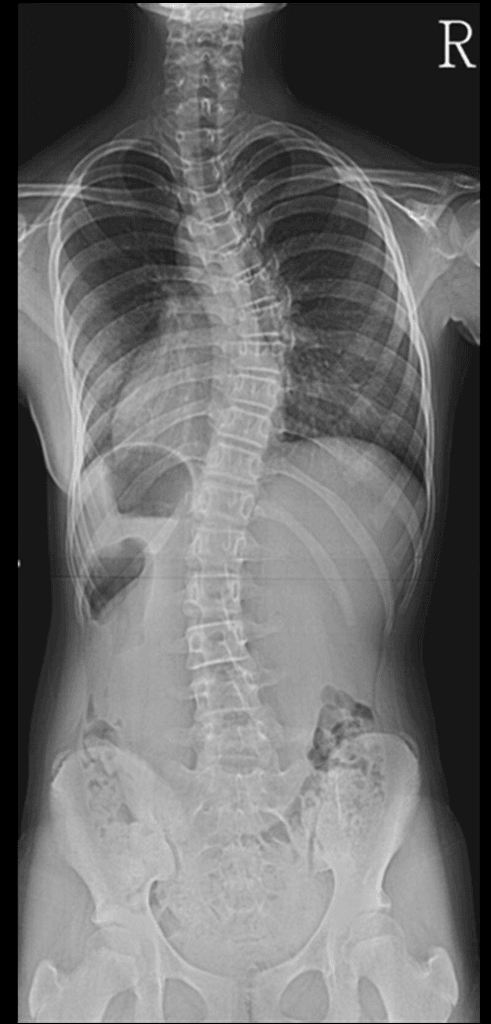Full spine radiograph showing vertebral wedging in scoliosis