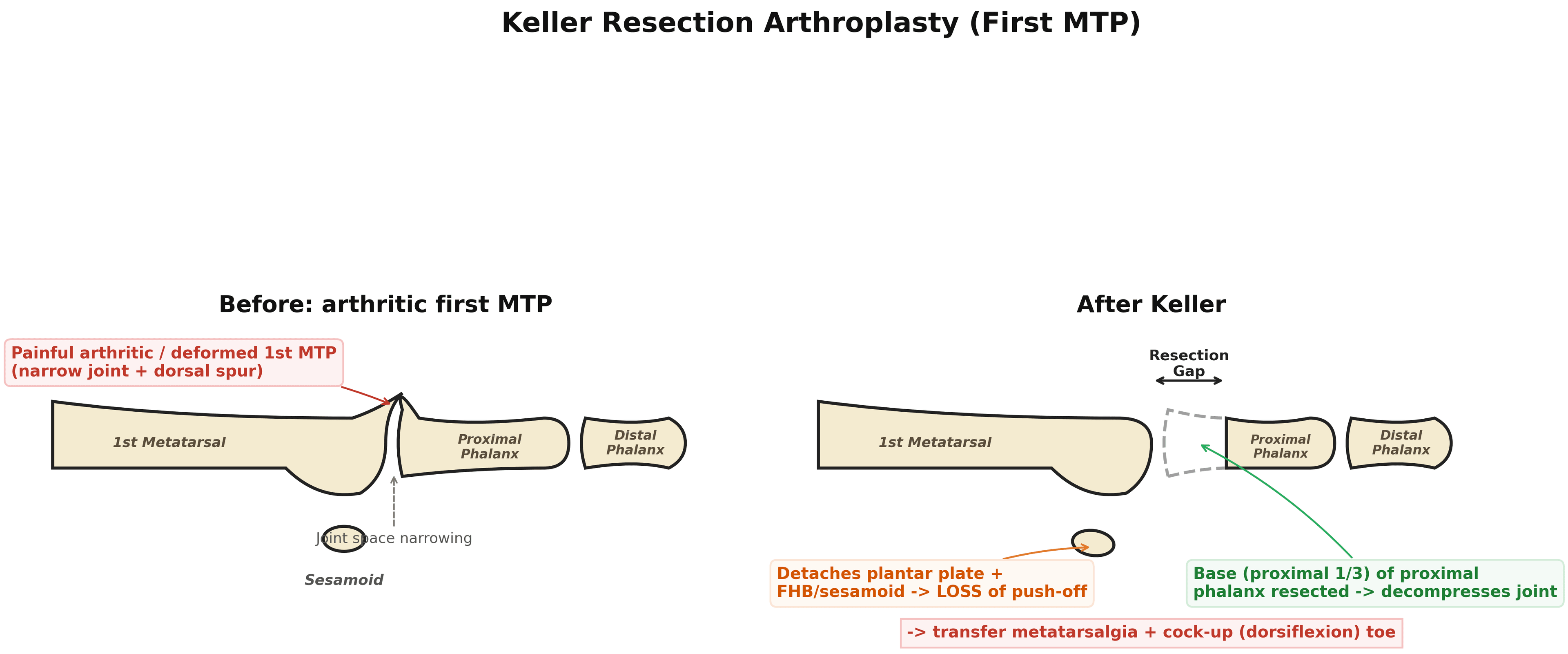 Before-and-after diagram of Keller resection arthroplasty: an arthritic first MTP joint, then resection of the proximal third of the proximal phalanx leaving a gap that decompresses the joint
