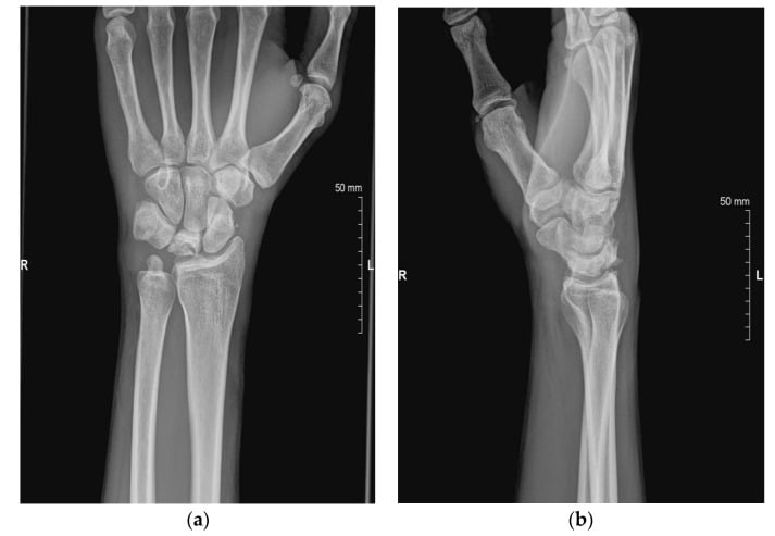 Frontal (a) and lateral (b) wrist radiographs of Lichtman stage IIIA Kienböck disease