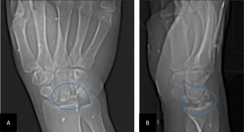 Frontal (A) and lateral (B) radiographs with an isolated collapsed lunate circled