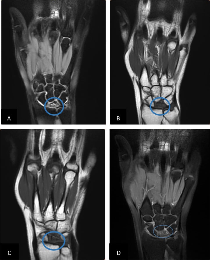 Four-panel coronal multisequence MRI, with gadolinium enhancement, of a collapsed lunate