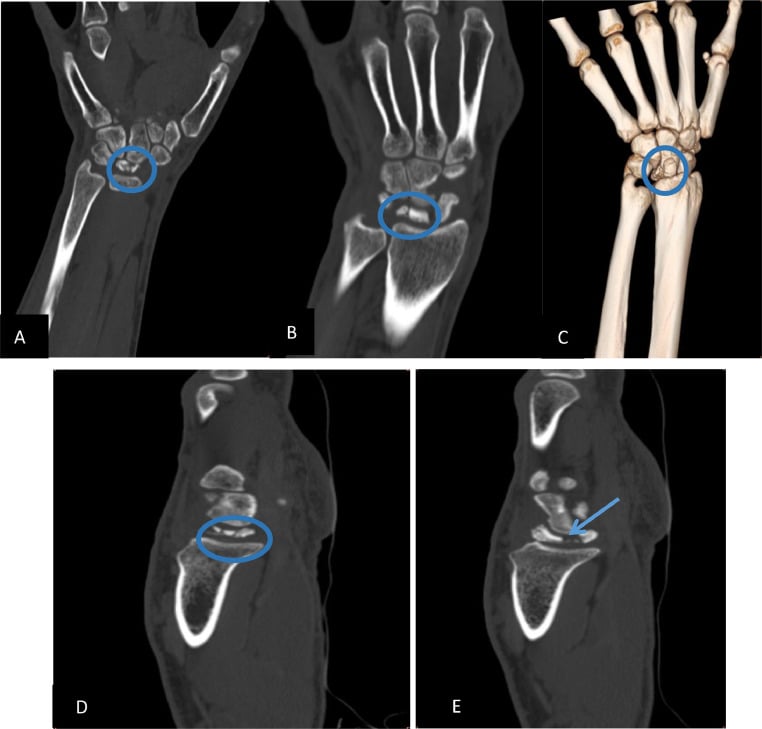 CT of a fragmented lunate: coronal reformats, a three-dimensional reconstruction and sagittal reformats