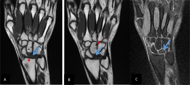 Three-panel coronal MRI of a collapsed lunate with radiocarpal and midcarpal arthritis, arrows on the lunate and adjacent joints