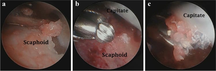 Three arthroscopic views (a-c) of scaphoid and capitate fusion-surface preparation, with a burr in view
