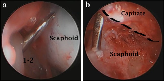 Arthroscopic radiocarpal and midcarpal views of guidewire placement for scaphocapitate fusion