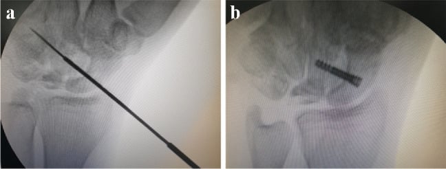 Fluoroscopic images of cannulated drilling and headless-screw fixation of scaphocapitate fusion