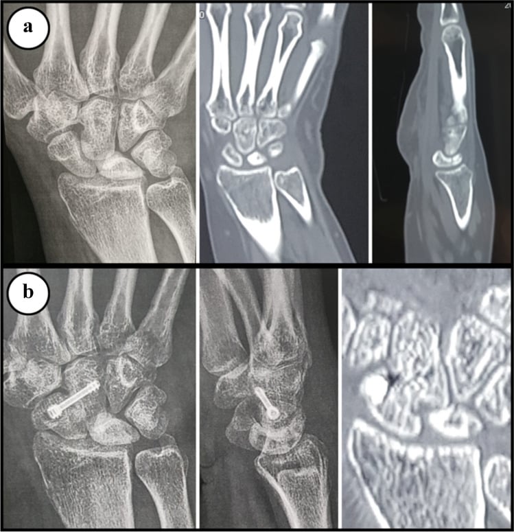 Preoperative and postoperative radiographs and CT of scaphocapitate fusion