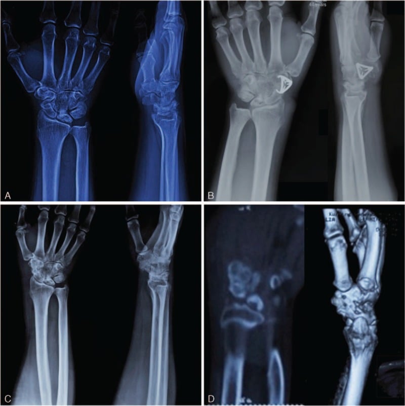 Serial radiographs and CT before and after STT arthrodesis