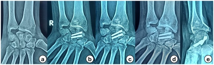 Serial radiographs (a-e) after scaphocapitate fusion for stage III Kienböck disease